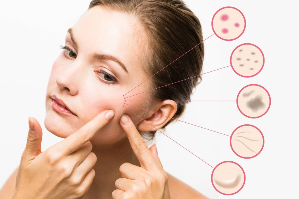 Different Acne Scar Treatments: Chemical Peels, Microneedling, and Laser Therapy