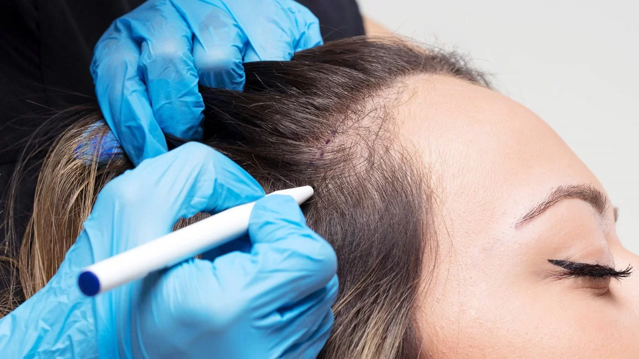 Hair Thinning and Hair Loss