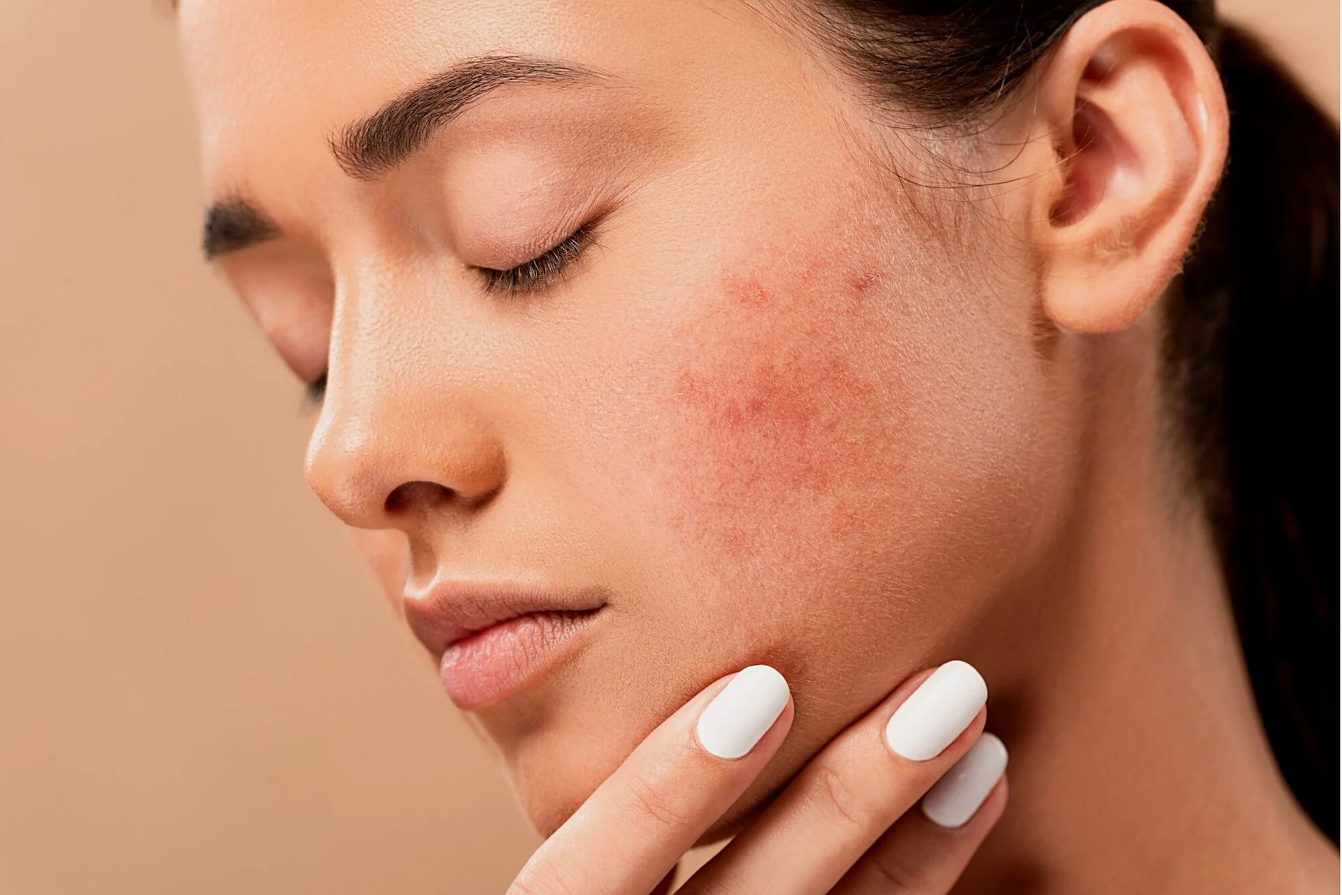 Acne and Scars Treatments