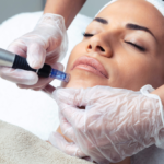 Microneedling for Various Skin Concerns: Acne Scars, Wrinkles, and Hyperpigmentation