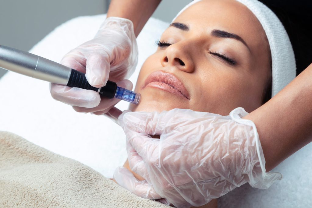 Microneedling for Various Skin Concerns: Acne Scars, Wrinkles, and Hyperpigmentation