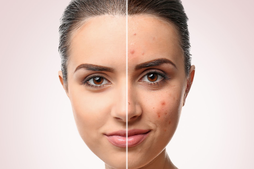 Different Acne Scar Treatments: Chemical Peels, Microneedling, and Laser Therapy