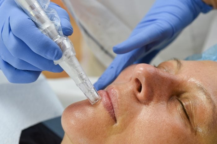 Close-up of a woman undergoing a microneedling treatment by a dermatologist, commonly used to stimulate collagen and reduce signs of aging.