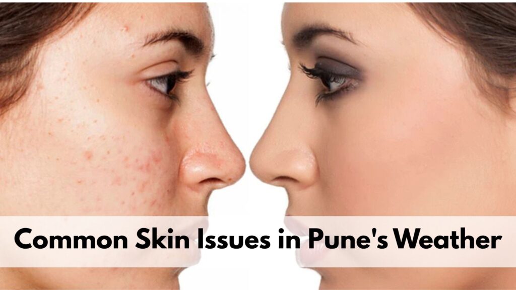 Before and after comparison of skin affected by acne and pigmentation, highlighting common skin issues caused by Pune's weather.