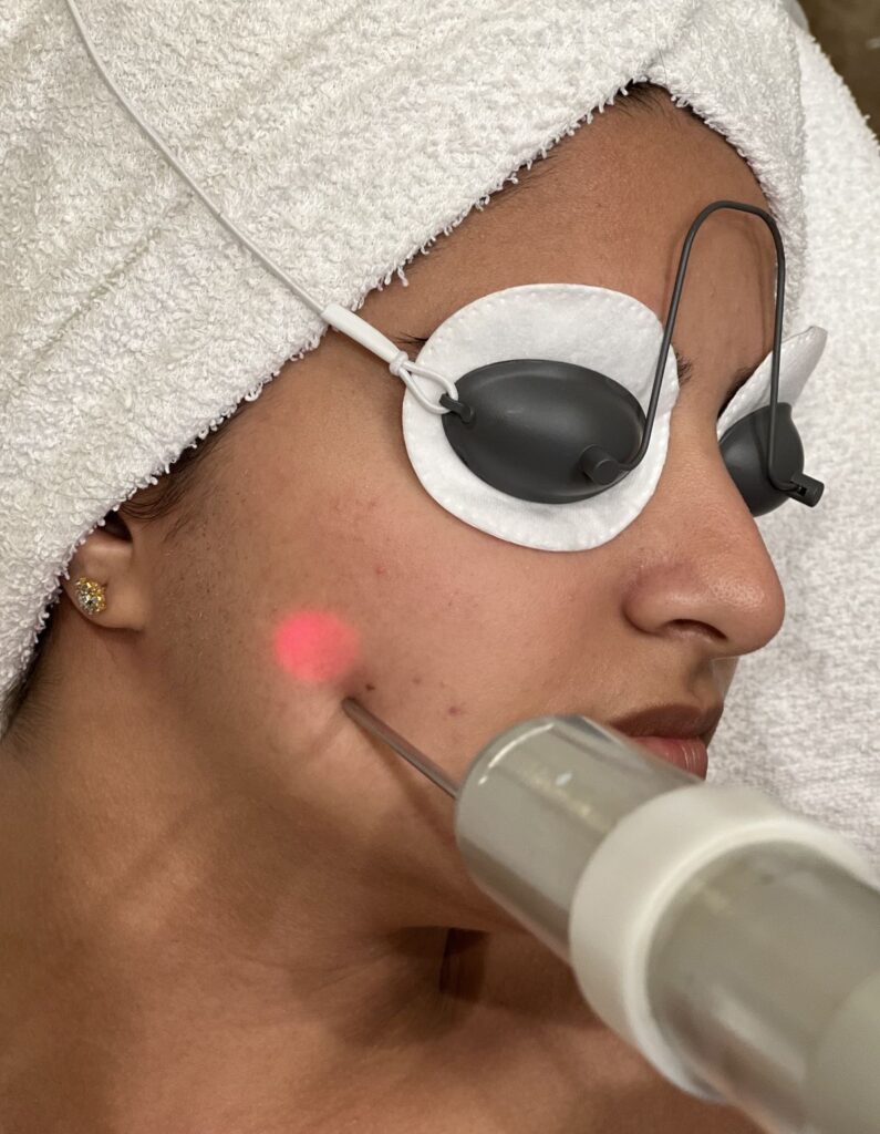 Laser treatment safety for Indian skin at VLCC Beauty Clinic Wakad