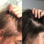 Post-COVID and stress-related hair fall treatment at VLCC Salon & Cosmetology Clinic Wakad Pune using PRP, mesotherapy, laser therapy, and scalp detox.