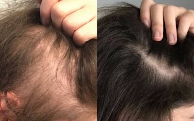 Post-COVID and stress-related hair fall treatment at VLCC Salon & Cosmetology Clinic Wakad Pune using PRP, mesotherapy, laser therapy, and scalp detox.