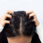 Difference between dandruff and dry scalp during monsoon season with symptoms, causes, and scalp care tips for healthy hair.