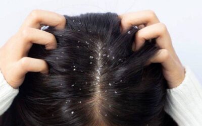 Dandruff vs Dry Scalp: Understanding the Difference This Monsoon Difference between dandruff and dry scalp during monsoon season with symptoms, causes, and scalp care tips for healthy hair.